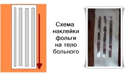 Алюмінієва фольга для суглобів способи використання (фольга) Алюмінієва фольга для суглобів способи використання