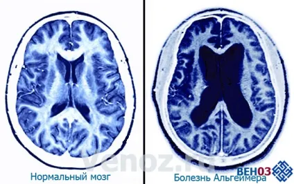 Альцгеймера хвороба лікування народними засобами деменції (недоумства) (засобами) Альцгеймера хвороба лікування народними засобами деменції (недоумства)