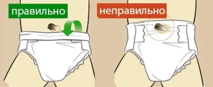 Як правильно обробляти пупок новонародженого - сайт про розвиток дитини (новонароджений) Як правильно обробляти пупок новонародженого - сайт про розвиток дитини