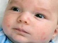 Як проявляється алергія на мед у дітей і дорослих і як лікувати патологію (алергія на мед симптоми у дітей) Як проявляється алергія на мед у дітей і дорослих і як лікувати патологію