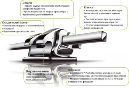 Як працюють брекети для зубів принцип дії системи (працюють) Як працюють брекети для зубів принцип дії системи
