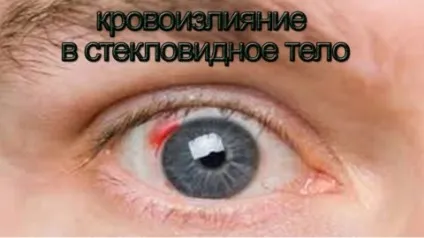Як зміцнити судини око поради та рекомендації, uflebologa (як зміцнити судини очей) Як зміцнити судини очей поради та рекомендації, uflebologa