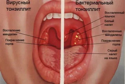 Як прибрати гній з мигдалин при ангіні у дитини в домашніх умовах (гній) Як прибрати гній з мигдалин при ангіні у дитини в домашніх умовах