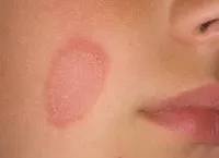 Як виглядає грибок фото, аптека в будинку (як виглядає грибок на ногах фото) Як виглядає грибок фото, аптека в будинку