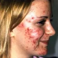 Як виглядає грибок фото, аптека в будинку (як виглядає грибок стоп) Як виглядає грибок фото, аптека в будинку