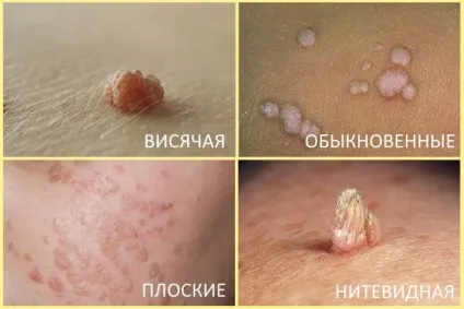 Як виглядає бородавка на ногах, руках і області геніталій основні різновиди (ногах) Як виглядає бородавка на ногах, руках і області геніталій основні різновиди