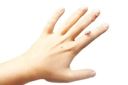 Як виглядає бородавка на ногах, руках і області геніталій основні різновиди (області) Як виглядає бородавка на ногах, руках і області геніталій основні різновиди