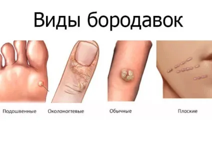 Як виглядає бородавка на ногах, руках і області геніталій основні різновиди (бородавка) Як виглядає бородавка на ногах, руках і області геніталій основні різновиди