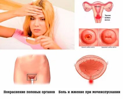 Як виглядає хламідіоз на фото у жінок і чоловіків (чоловіків) Як виглядає хламідіоз на фото у жінок і чоловіків