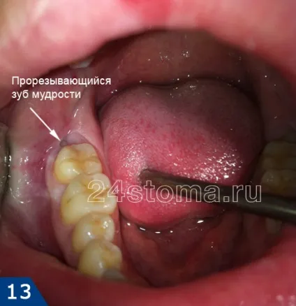 Як виривають зуб мудрості