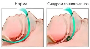 Апарат для лікування апное сну купити в Харкові - медтехніка та запчастини інтернет-магазин в (спб) Апарат для лікування апное сну купити в Харкові - медтехніка та запчастини інтернет-магазин в