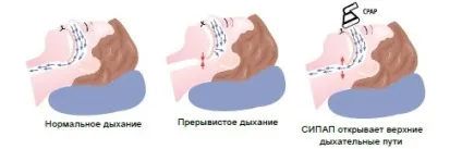 Апарат від хропіння огляд дієвих пристосувань (чоловіче здоров'я андрологія) Апарат від хропіння огляд дієвих пристосувань