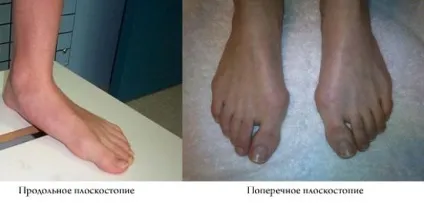 Артроз плюсневого суглоба причини, симптоми, лікування (фото) (артроз) Артроз плюсневого суглоба причини, симптоми, лікування (фото)