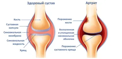 Артрит колінного суглоба у дітей причини, симптоми, лікування і вікові особливості (колінного) Артрит колінного суглоба у дітей причини, симптоми, лікування і вікові особливості
