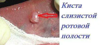 Кіста в роті лікування у дитини і дорослого (лікування) Кіста в роті лікування у дитини і дорослого