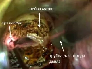 Коагуляція шийки матки - що це таке, види коагуляції (коагуляція) Коагуляція шийки матки - що це таке, види коагуляції