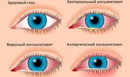 Кон'юнктивіт заразний чи ні, скільки днів, у дорослих, вірусний (Алергічний кон'юнктивіт супроводжується) Кон'юнктивіт заразний чи ні, скільки днів, у дорослих, вірусний