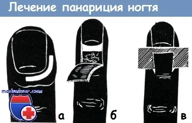 Шкірний панарицій і панарицій нігтя (пароніхія) - діагностика, лікування (панарицій нігтя) Шкірний панарицій і панарицій нігтя (пароніхія) - діагностика, лікування