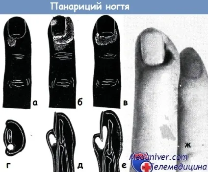 Шкірний панарицій і панарицій нігтя (пароніхія) - діагностика, лікування (панарицій нігтя) Шкірний панарицій і панарицій нігтя (пароніхія) - діагностика, лікування