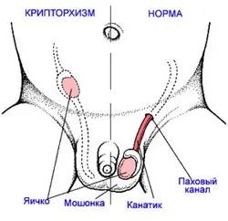 Крипторхізм у чоловіків види і методи лікування (крипторхізм у чоловіків) Крипторхізм у чоловіків види і методи лікування