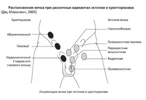 Крипторхізм у чоловіків види і методи лікування (крипторхізм) Крипторхізм у чоловіків види і методи лікування