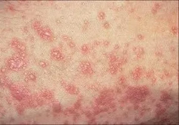 Червоний плаский лишай