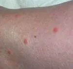 Лікування укусів постільних клопів, їх симптоми і засоби (постільних) Лікування укусів постільних клопів, їх симптоми і засоби