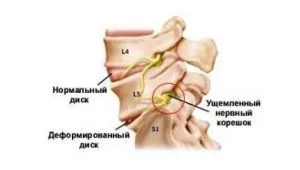 Лазеротерапія при остеохондрозі техніка проведення та відгуки пацієнтів (пацієнтів) Лазеротерапія при остеохондрозі техніка проведення та відгуки пацієнтів