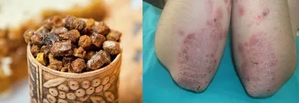 Лікування псоріазу прополісом, медом, пергою та іншими продуктами бджільництва (псоріазу) Лікування псоріазу прополісом, медом, пергою та іншими продуктами бджільництва