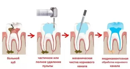 Лікування пульпіту зуба, методи і етапи (зуба) Лікування пульпіту зуба, методи і етапи