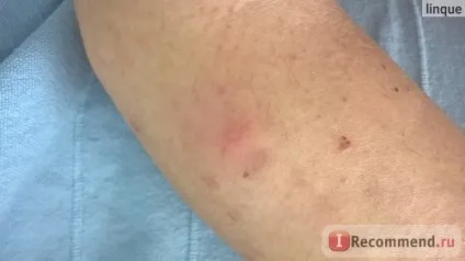Лазерна епіляція - «оновлений що вибрати лазерну, електро або фотоепіляції (електро) Лазерна епіляція - «оновлений що вибрати лазерну, електро або фотоепіляції