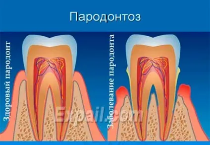 Лікування пародонтозу вартість лікування недорого (пародонтозу) Лікування пародонтозу вартість лікування недорого