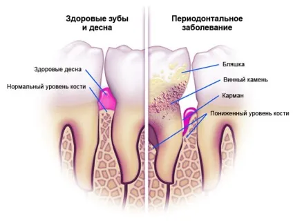 Лікування пародонтозу в Запоріжжя недорого мкс стоматологія симптоми, чинники (симптоми) Лікування пародонтозу в Запоріжжя недорого мкс стоматологія симптоми, чинники