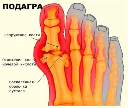 Лікування п'явками подагри (лікування) Лікування п'явками подагри