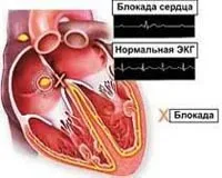Атріовентрикулярна блокада - причини, симптоми, діагностика та лікування (симптоми) Атріовентрикулярна блокада - причини, симптоми, діагностика та лікування
