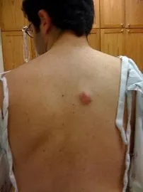 Атерома на спині небезпечно дане захворювання, onkostatus (атерома) Атерома на спині небезпечно дане захворювання, onkostatus
