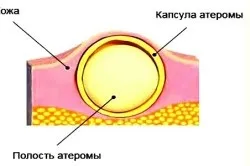 Атерома вуха і її лікування (атерома) Атерома вуха і її лікування