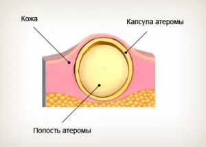 Атерома на шиї причини