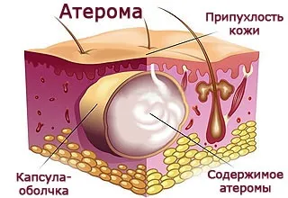 Атерома вушної раковини і мочки вуха - лікування кісти (кіста) Атерома вушної раковини і мочки вуха - лікування кісти