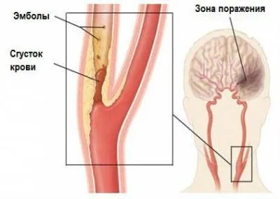 Атеросклеротична бляшка в сонній артерії і лікування таких змін (бляшка) Атеросклеротична бляшка в сонній артерії і лікування таких змін