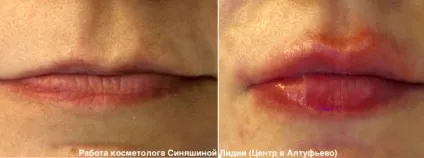 Асиметрія губ на обличчі причини, як виправити (виправлення асиметрії губ) Асиметрія губ на обличчі причини, як виправити