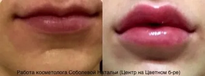 Асиметрія губ на обличчі причини, як виправити (асиметрія нижньої губи) Асиметрія губ на обличчі причини, як виправити