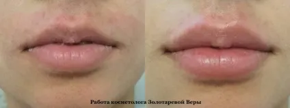 Асиметрія губ на обличчі причини, як виправити (виправлення асиметрії губ гіалуроновою кислотою) Асиметрія губ на обличчі причини, як виправити