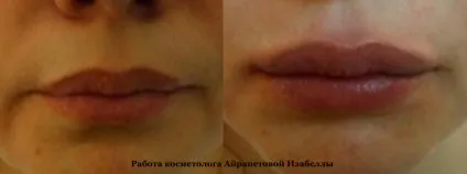 Асиметрія губ на обличчі причини, як виправити (асиметрія після збільшення губ) Асиметрія губ на обличчі причини, як виправити