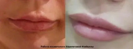 Асиметрія губ на обличчі причини, як виправити (особі) Асиметрія губ на обличчі причини, як виправити