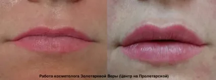 Асиметрія губ на обличчі причини, як виправити (усунення асиметрії губ) Асиметрія губ на обличчі причини, як виправити