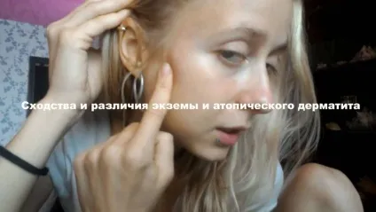 Атопічний дерматит або екзема методи визначення захворювання (дерматит) Атопічний дерматит або екзема методи визначення захворювання