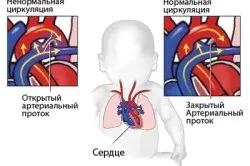 Марс хвороби серця