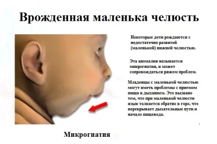 Маленька щелепу - причини і що можна зробити (щелепа) Маленька щелепу - причини і що можна зробити