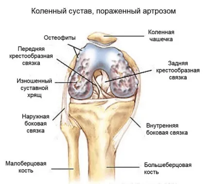 Масаж коліна при артрозі в домашніх умовах (масаж) Масаж коліна при артрозі в домашніх умовах